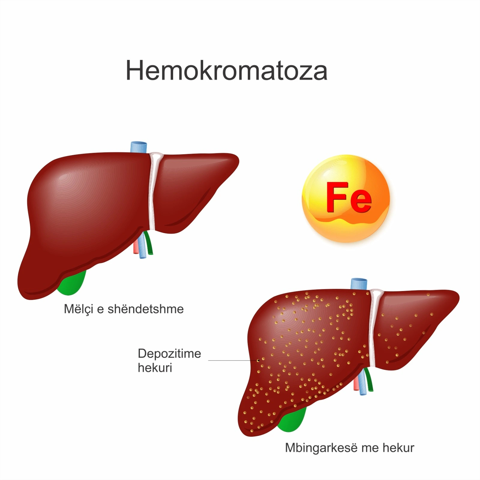 Diagram i melcise se shendetshme dhe melcise se mbingarkuar me hekur.