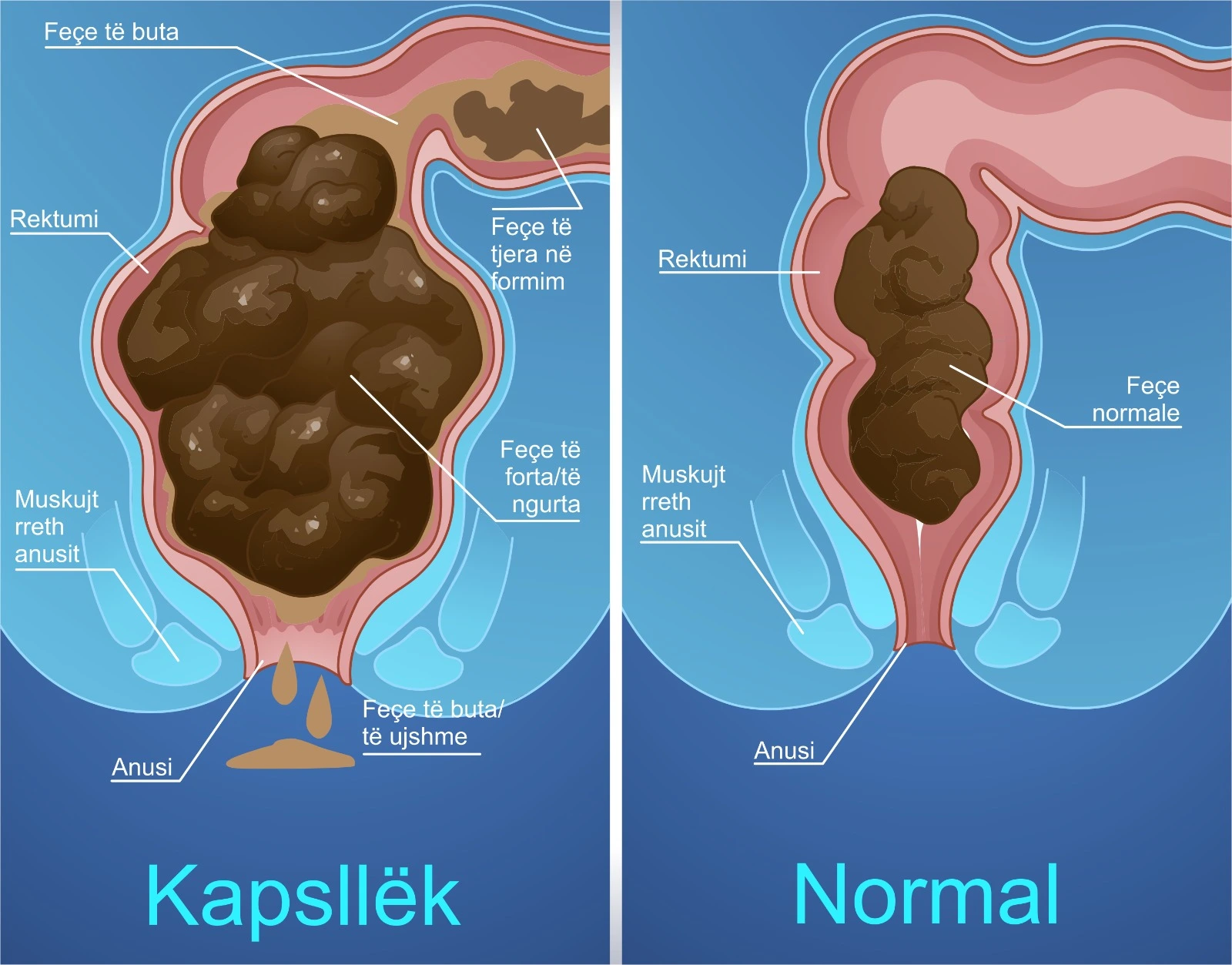 Diagram që krahason kapsllëkun me jashtëqitjen normale në zorrën e trashë