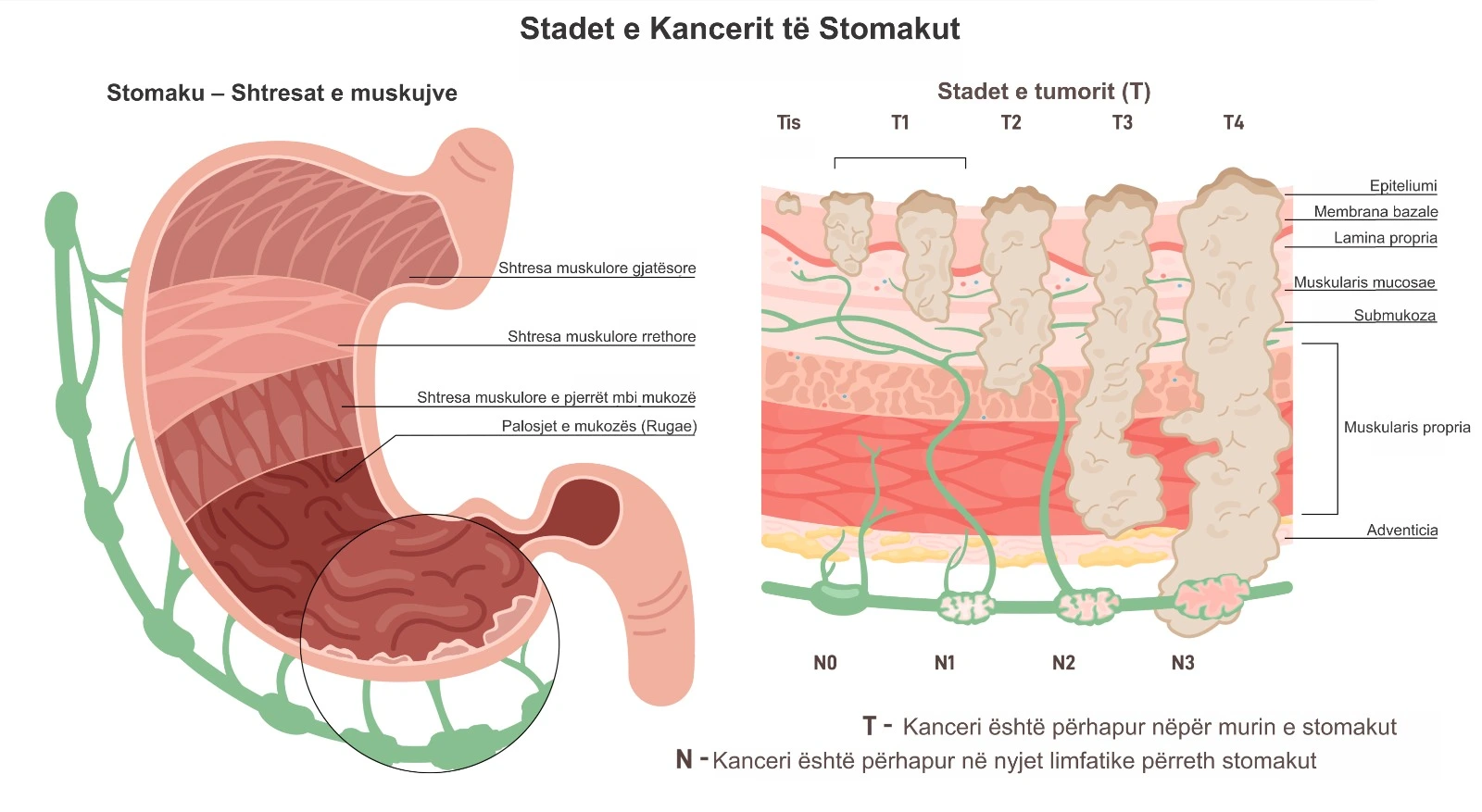 Diagram qe tregon stadet e kancerit te stomakut