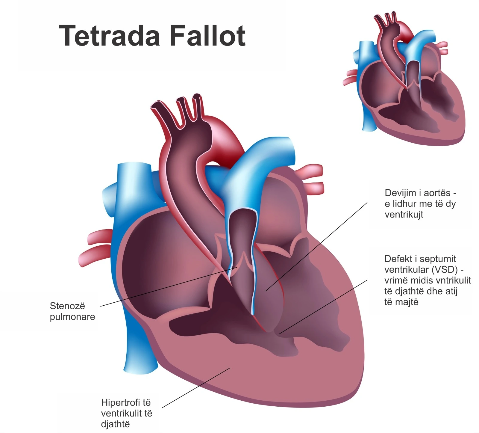 Tetrada Fallot është një defekt i lindur i zemrës që përfshin stenozë pulmonare, defekt të septumit ventrikular, devijim të aortës dhe hipertrofi të ventrikulit të djathtë.